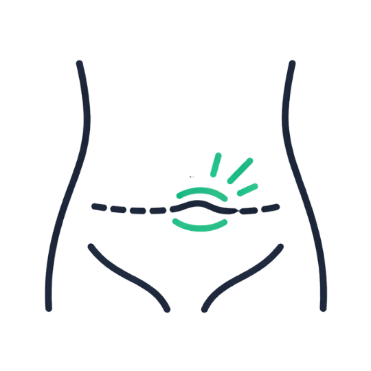 Ventral & Incisional Hernia Repairing weak spots from previous surgeries.