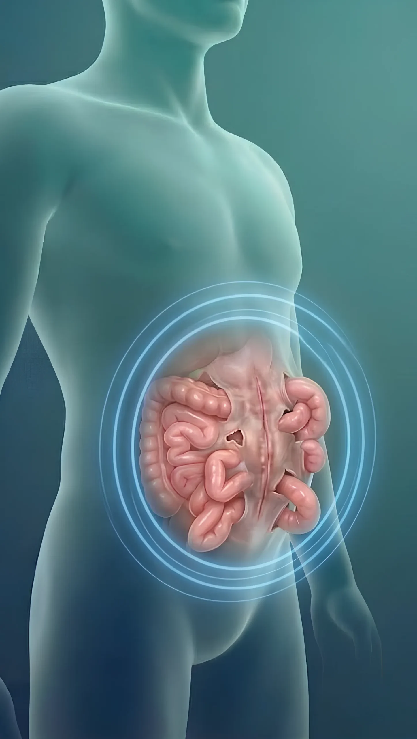 What is Complex and Recurrent Hernias - By Dr Harsh Shah