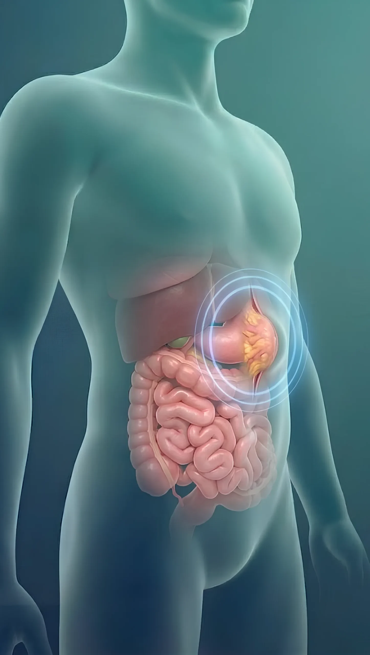 What is Epigastric Hernia - Dr Harsh Shah